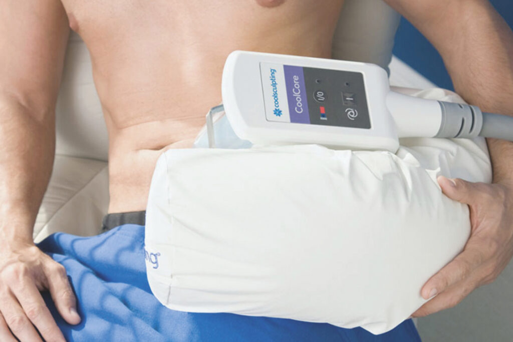 Emsculpt: CoolSculpting-Gerät während einer Kältebehandlung am Bauch.