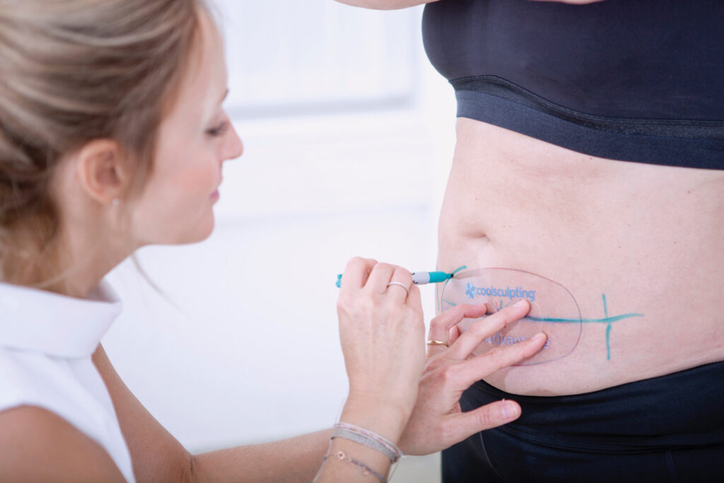 Emsculpt: Vorbereitung einer CoolSculpting-Behandlung mit Markierung am Bauch.“